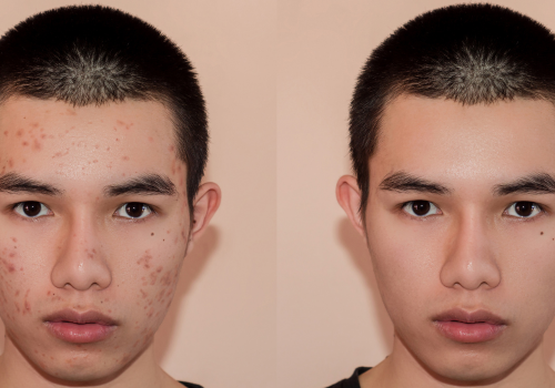 Scar removal treatment
