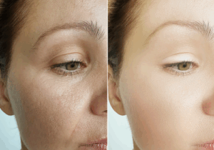 Under eye treatment